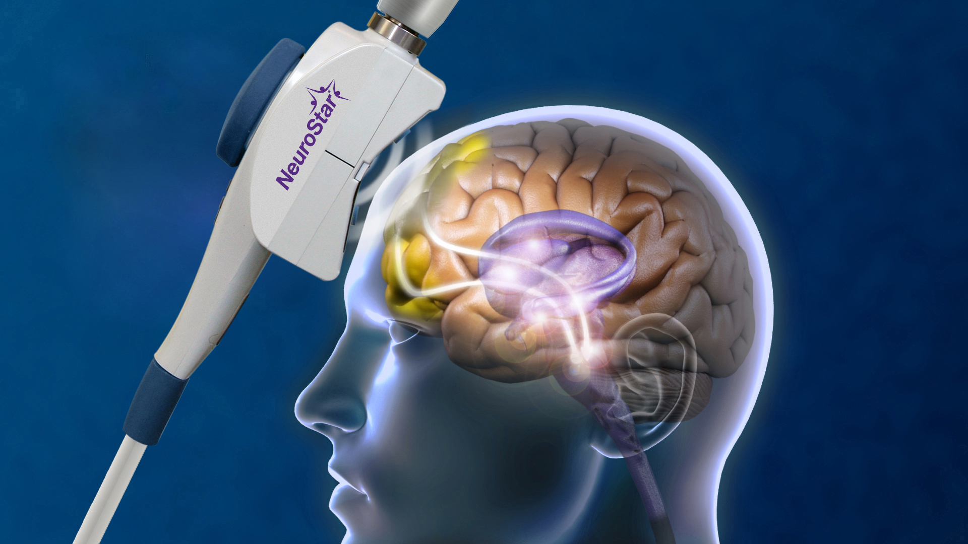 NeuroStar TMS Treatment